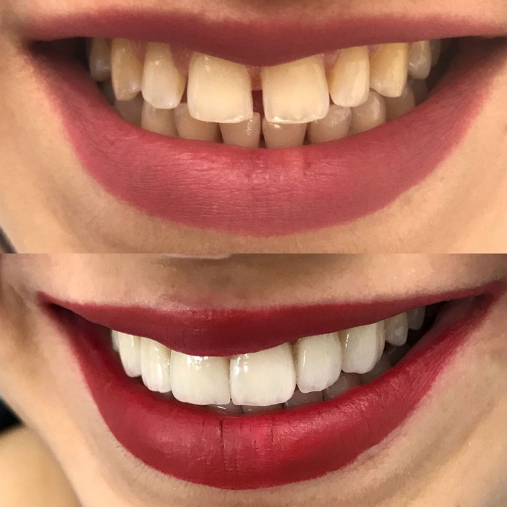 Gülüş Tasarımı Nedir?